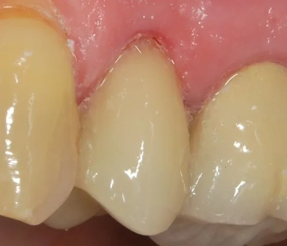 CEREC case after treatment
