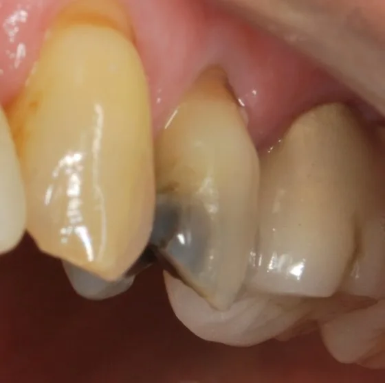 CEREC case before treatment