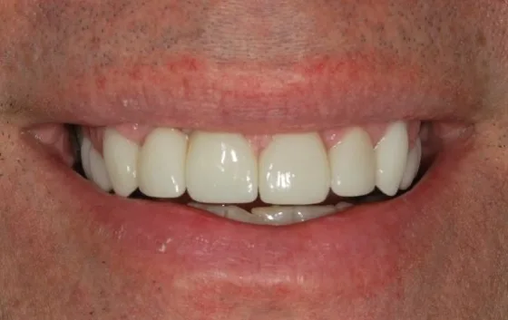 Combination restorative case after treatment