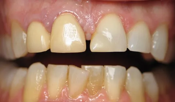 Combination restorative case before treatment