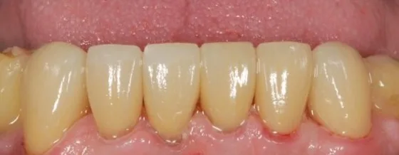 Crown restoration case after treatment