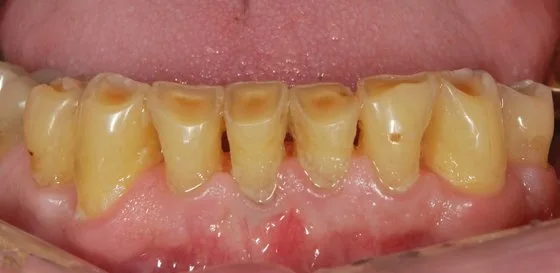 Crown restoration case before treatment