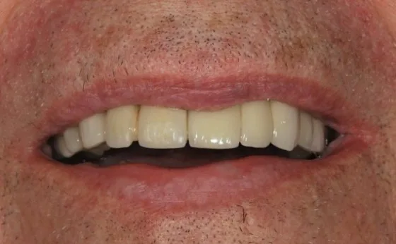Dental implant reconstruction after treatment