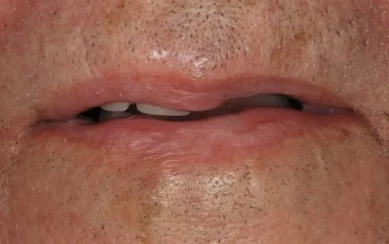 Dental implant reconstruction before treatment
