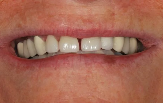 Porcelain veneers case after treatment