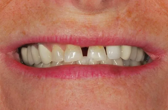 Porcelain veneers case before treatment