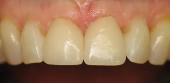 Veneers case after treatment