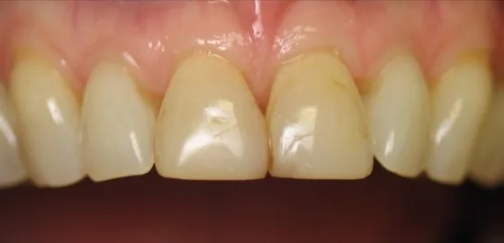 Veneers case before treatment